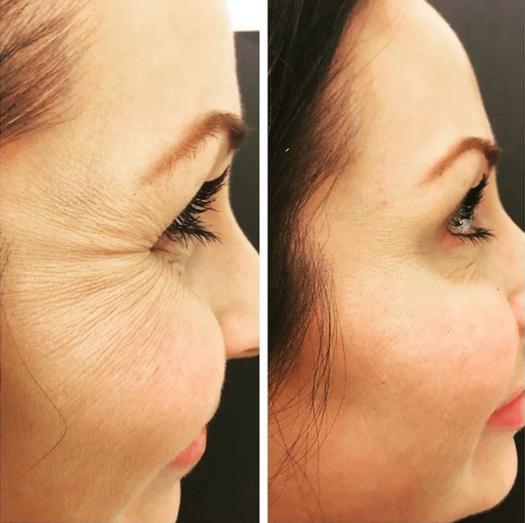 Anti-wrinkle treatment before and after