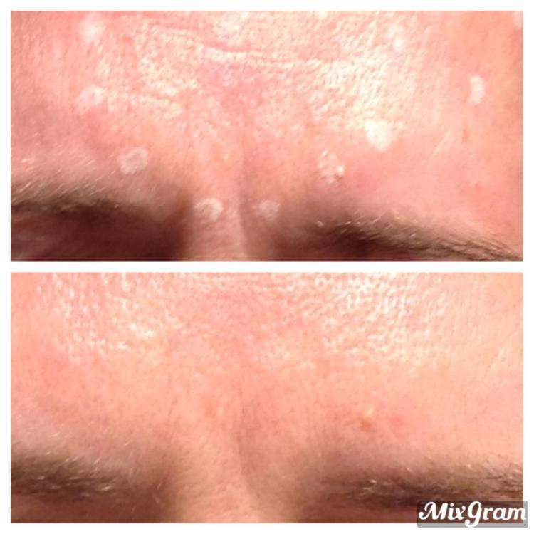 Anti-wrinkle treatment before and after by Dr Rashidy at Cosmeticine clinic Kew
