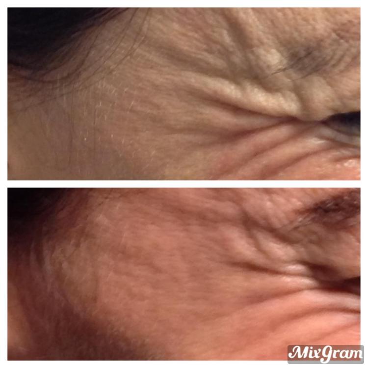Anti-wrinkle treatment before and after by Dr Rashidy at Cosmeticine clinic Kew