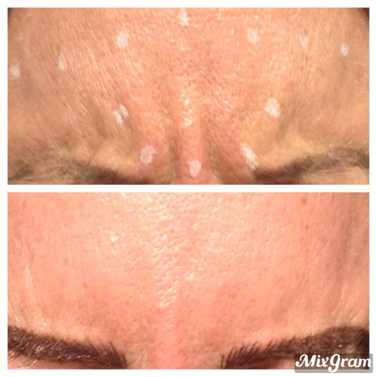 Anti-wrinkle treatment by Dr Rashidy at Cosmeticine clinic Kew